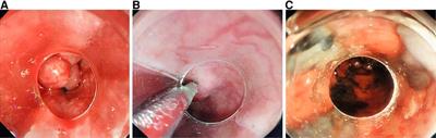 Esophageal variceal ligation plus sclerotherapy vs. ligation alone for the treatment of esophageal varices